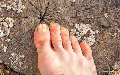 Toenail Fungus