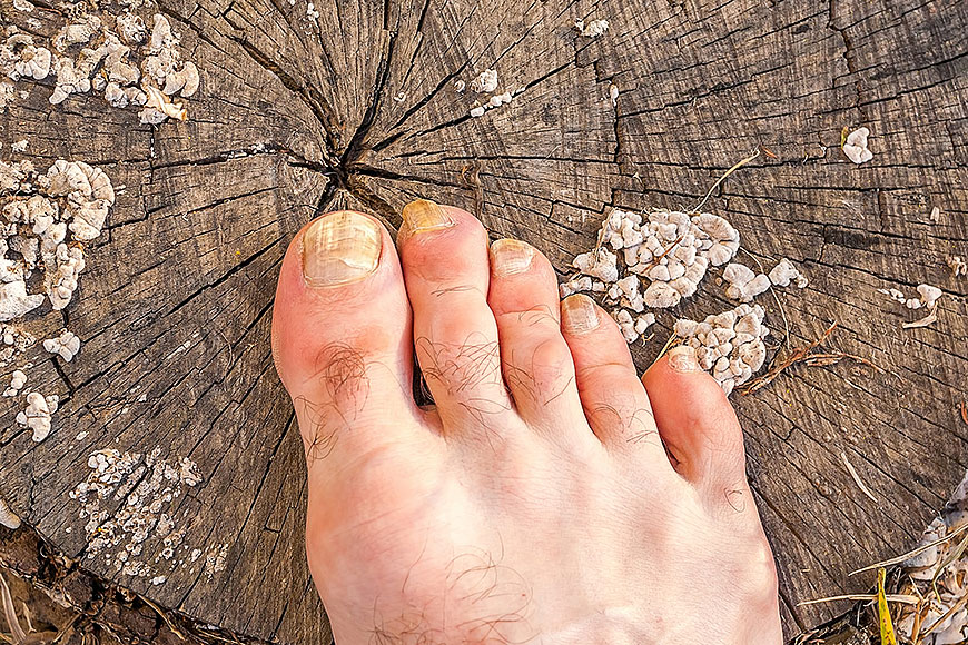 Toenail Fungus