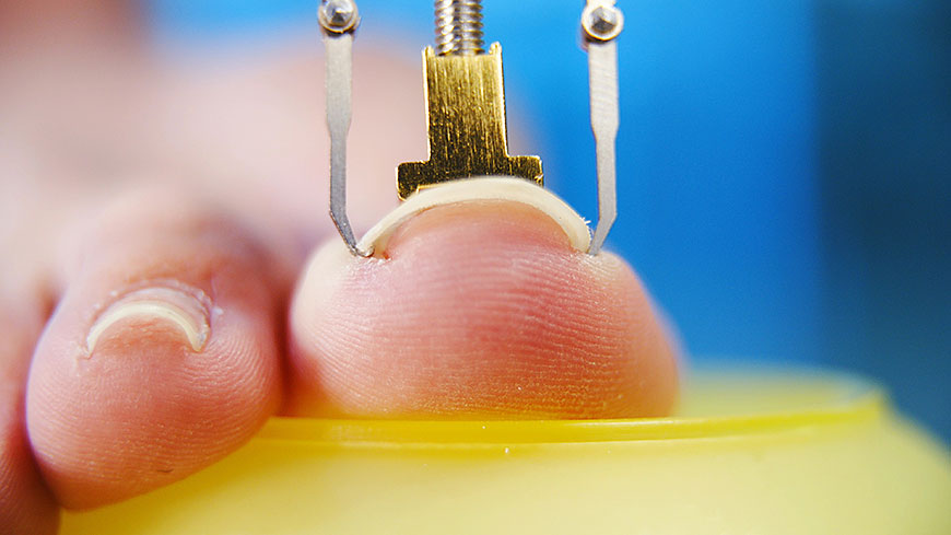 Condiciones de las uñas de los pies