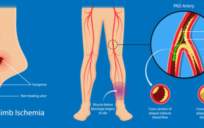 Peripheral Arterial Disease