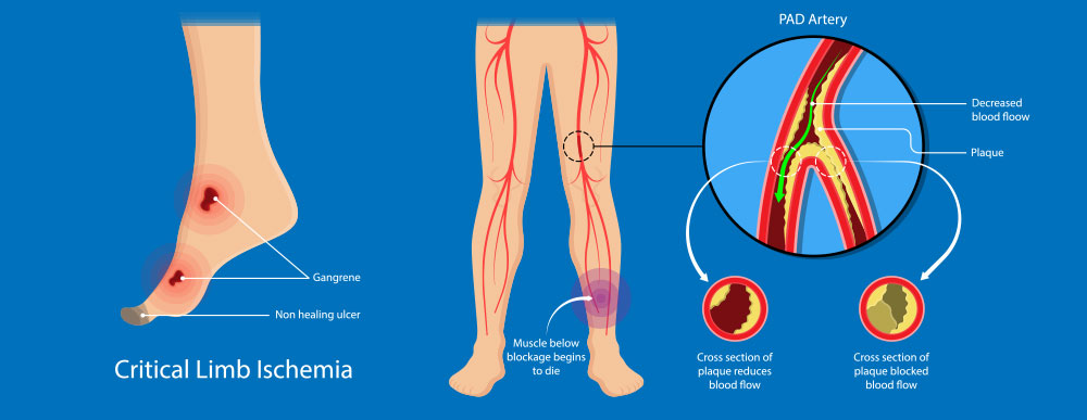 Peripheral Arterial Disease